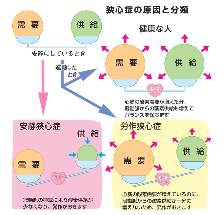 狭心症の原因と分類の図。健康な人は運動時に酸素の需要が増えた分だけ供給も増えて天秤がつり合うが、労作狭心症では供給が追いつかず、安静狭心症では冠動脈の痙攣で供給が減って天秤が傾く