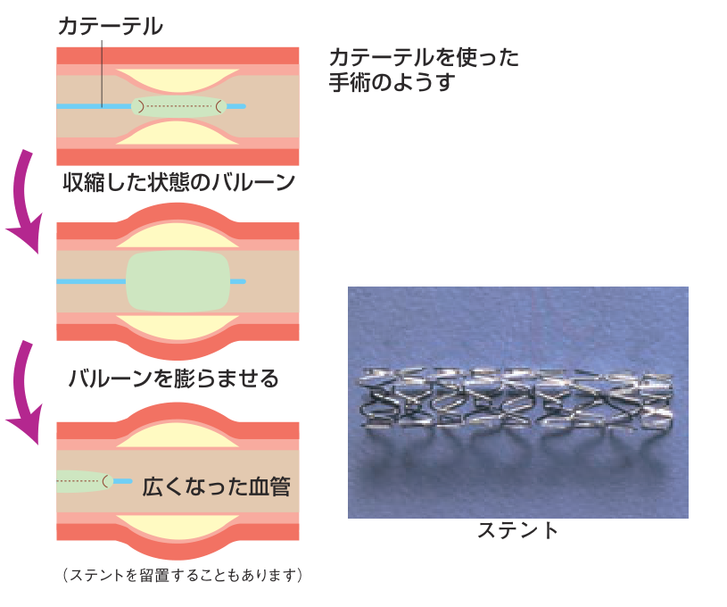 カテーテルを使った手術のようすを示した図。収縮した状態のバルーンを狭窄部分まで入れ、バルーンを膨らませて広くなった血管にする。あわせて筒状のステントの写真