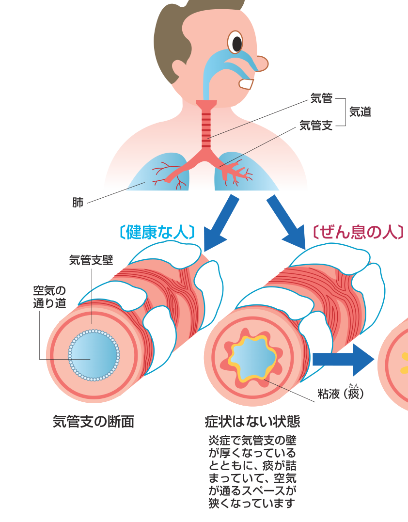 気管・気管支・肺の位置と、健康な人とぜん息の人の気管支断面を比べた図。ぜん息の人は症状がない状態でも気管支の壁が厚くなり、痰が詰まって空気の通り道が狭くなっている