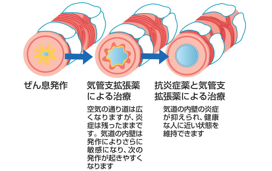 ぜん息発作から気管支拡張薬による治療、抗炎症薬と気管支拡張薬による治療へと気管支の断面が変化していくようすを示した図
