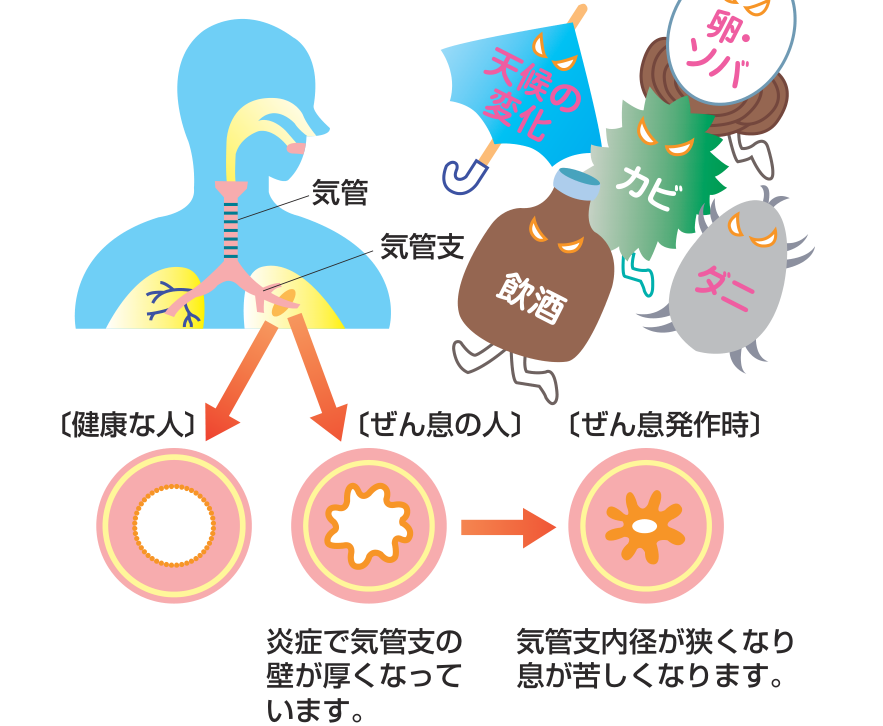 天候の変化・卵やソバなどの食べもの・カビ・ダニ・飲酒といった刺激が加わると気管支に炎症が起き、健康な人・ぜん息の人・ぜん息発作時で気管支の内径が変化するようすを示した図