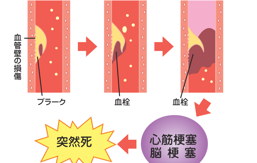 血管壁の損傷部にできたプラークが破裂し、そこに血栓ができて血管を塞ぎ、心筋梗塞・脳梗塞から突然死に至る流れを示した図