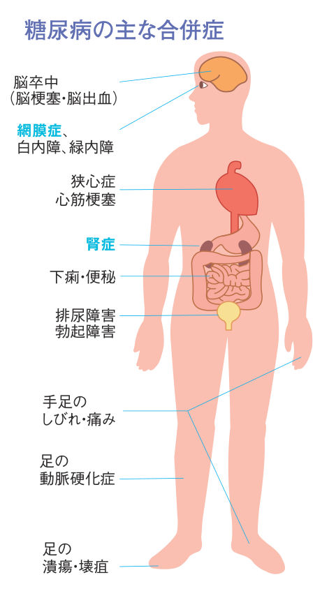 糖尿病の主な合併症を全身の図で示したもの。脳卒中（脳梗塞・脳出血）、網膜症・白内障・緑内障、狭心症・心筋梗塞、腎症、下痢・便秘、排尿障害・勃起障害、手足のしびれ・痛み、足の動脈硬化症、足の潰瘍・壊疽