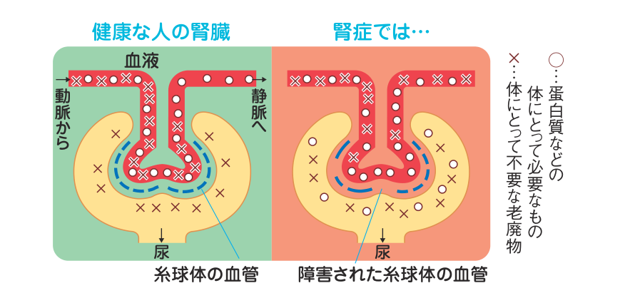 健康な人の腎臓と腎症の糸球体の血管を並べた図。健康な腎臓では体に必要な蛋白質などは血液中にとどまり不要な老廃物だけが尿へ出るが、障害された糸球体では必要なものまで尿へ漏れ出す