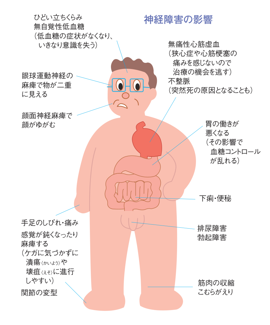 神経障害の影響を全身の図で示したもの。ひどい立ちくらみ、無自覚性低血糖、眼球運動神経の麻痺、顔面神経麻痺、無痛性心筋虚血、不整脈、胃の働きの低下、下痢・便秘、排尿障害・勃起障害、手足のしびれ・痛み、関節の変型、筋肉の収縮・こむらがえり