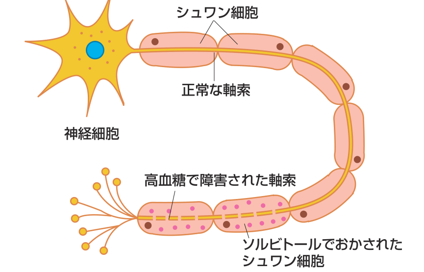 神経細胞から伸びる軸索と、それを包むシュワン細胞の図。正常な軸索に対し、高血糖で障害された軸索はソルビトールでおかされたシュワン細胞に包まれ、途切れている