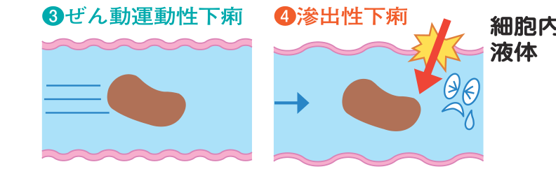 ぜん動運動性下痢では便が短時間で腸を通り抜け、滲出性下痢では炎症で細胞内の液体が腸内へ滲み出るようすを示した図