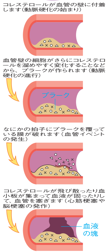 動脈硬化の進行と血管イベントを4段階で示した図。コレステロールが血管の壁に付着し、プラークが作られ、プラークを覆う膜が破れ、血液の塊が血管を塞ぐまでの流れ