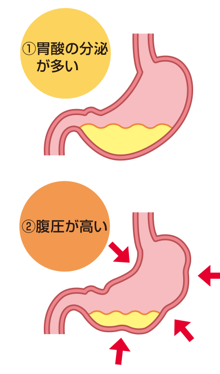 胃酸の分泌が多いタイプと腹圧が高いタイプという、胃食道逆流症の二大原因を示した胃のイラスト