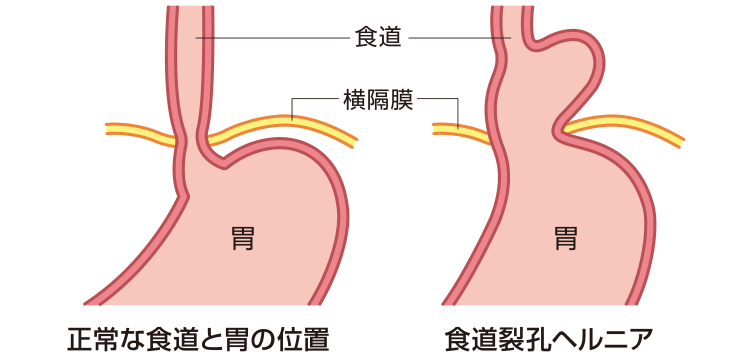 横隔膜を通る食道と胃の位置を示した図。正常な食道と胃の位置に対し、食道裂孔ヘルニアでは胃の上部が横隔膜より上に入り込んでいる