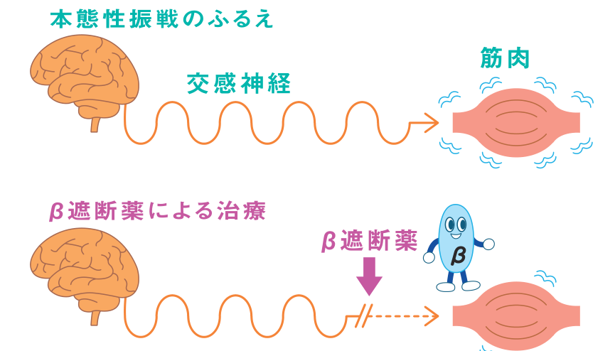 交感神経が筋肉を過剰に刺激してふるえが起こるしくみと、β遮断薬がその刺激を抑えてふるえを弱めるしくみを示した図