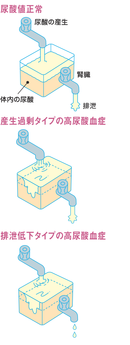 尿酸の産生と排泄を水槽にたとえた図。尿酸値正常、産生過剰タイプの高尿酸血症、排泄低下タイプの高尿酸血症の三つを比べている