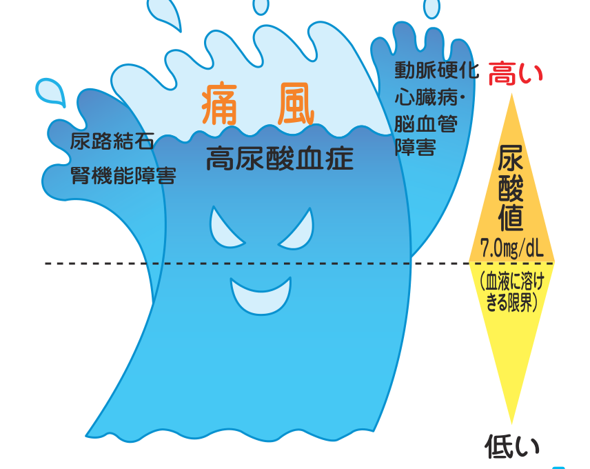 尿酸値が血液に溶けきる限界の7.0mg/dLを超えると、高尿酸血症から痛風、尿路結石、腎機能障害、動脈硬化による心臓病・脳血管障害が水面から現れることを波にたとえた図