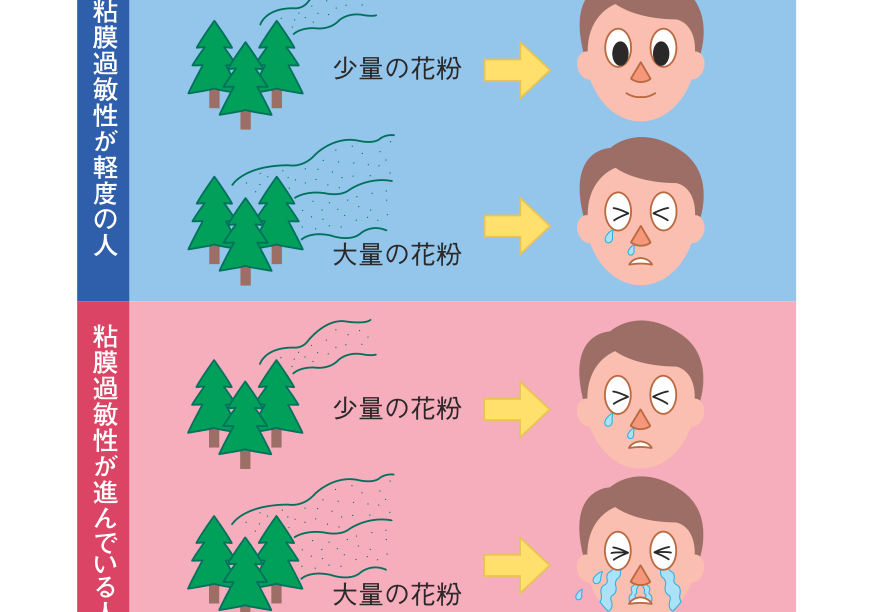 鼻粘膜の過敏性が軽度の人は大量の花粉を浴びても症状が軽く、過敏性が進んでいる人は少量の花粉でも症状が重くなることを示した図