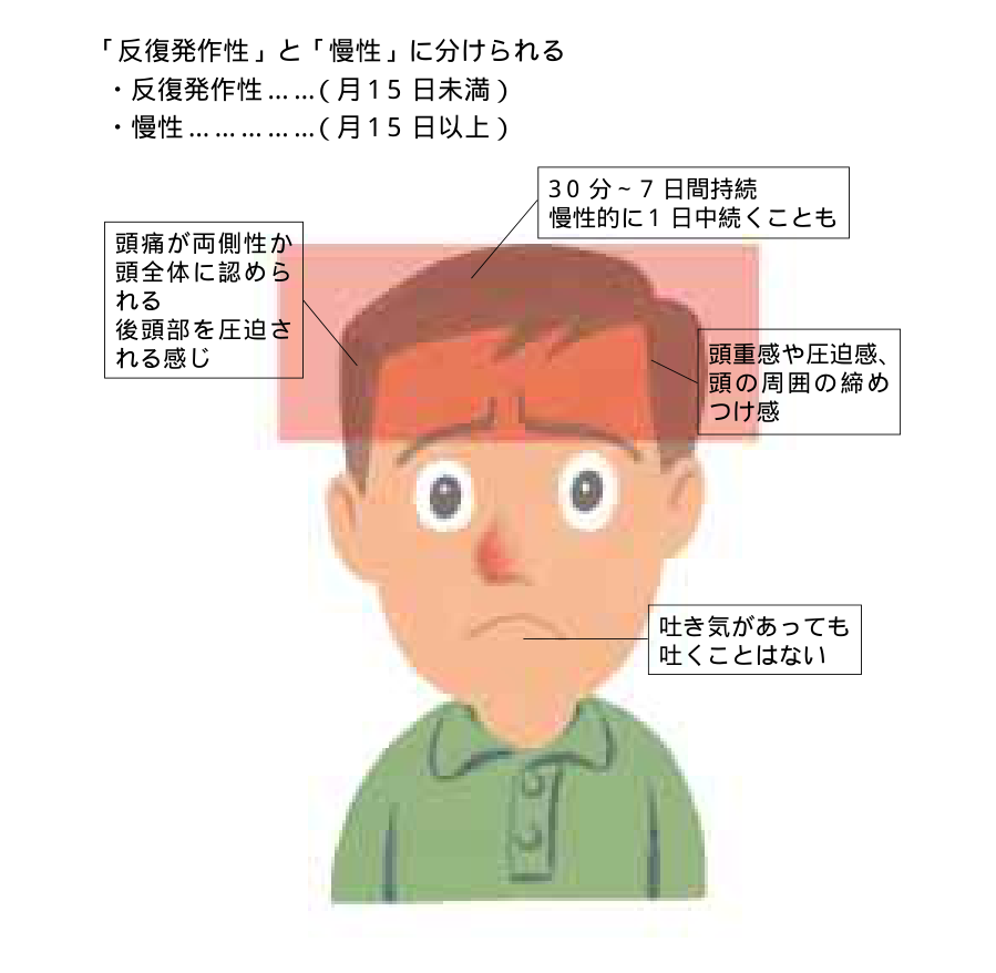 緊張型頭痛でみられる症状を頭部に示した図。頭全体や後頭部の圧迫感、頭重感や締めつけ感があり、吐き気があっても吐くことはないことを表す