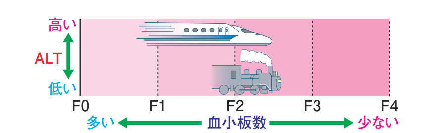 病期がF0からF4へ進むにつれて血小板数が少なくなること、ALTが高いほど病気が速く（新幹線のように）進み、低いほどゆっくり（蒸気機関車のように）進むことを示した図