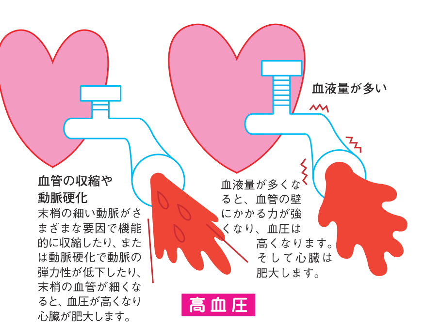 高血圧が起こる二つの仕組みの図。血管の収縮や動脈硬化で末梢の血管が細くなる場合と、血液量が多くなって血管の壁にかかる力が強くなる場合を、心臓を蛇口にたとえて示している