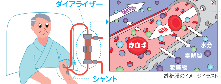 患者の腕のシャントからダイアライザー（透析器）へ血液を送り、透析膜を介して赤血球はそのまま通さず、水分・電解質・老廃物が血液側から透析液側へ移動するしくみを示した図