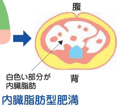 内臓脂肪型肥満のおなかの断面図。白色い部分が内臓脂肪で、内臓の周囲に溜まっている