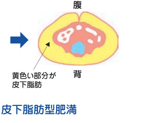 皮下脂肪型肥満のおなかの断面図。黄色い部分が皮下脂肪で、皮膚のすぐ内側に厚く溜まっている