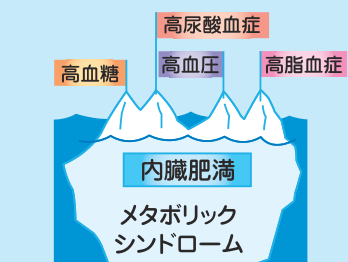 メタボリックシンドロームを氷山にたとえた図。海面下の大きな本体が内臓肥満で、海面上に突き出た小さな頂きが高血糖・高血圧・高尿酸血症・高脂血症として描かれている