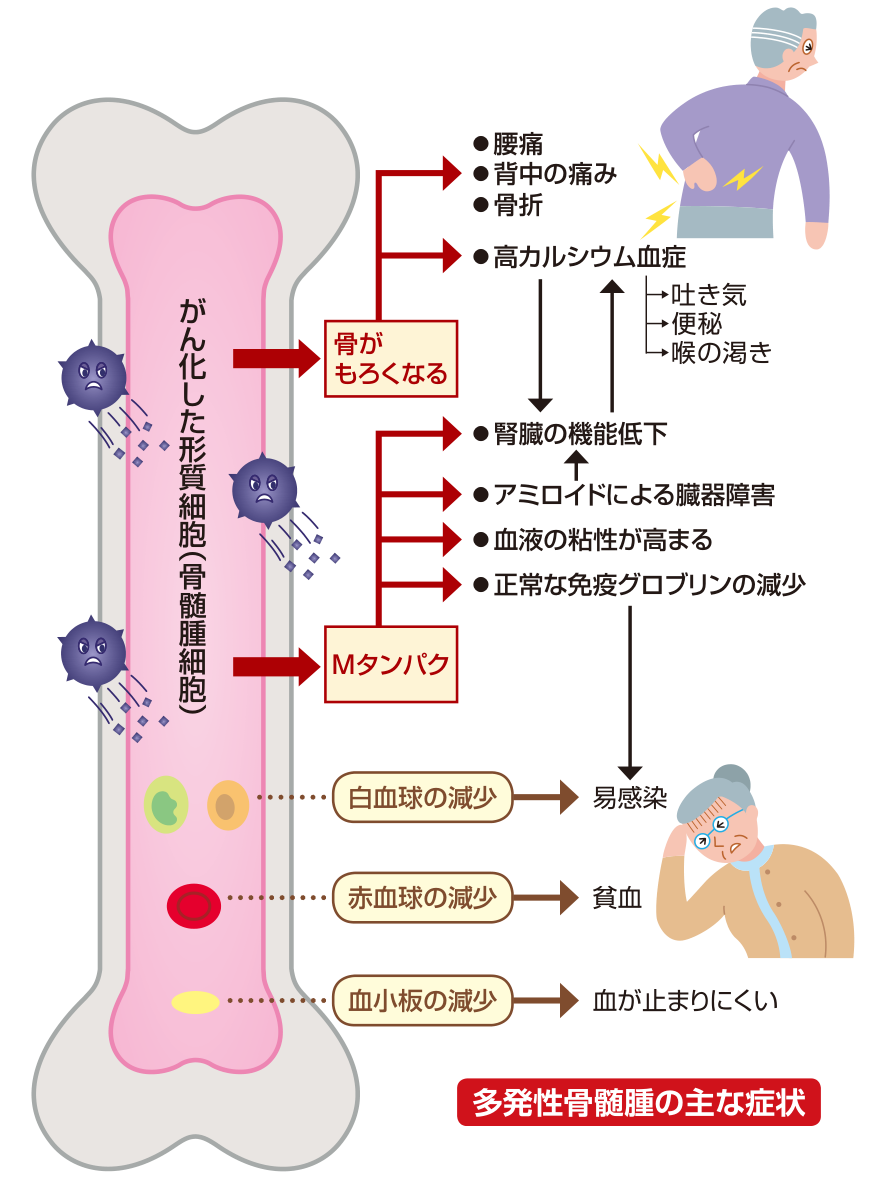 がん化した形質細胞(骨髄腫細胞)が骨をもろくして腰痛・背中の痛み・骨折・高カルシウム血症を招き、Mタンパクが腎臓の機能低下やアミロイドによる臓器障害を招くこと、白血球・赤血球・血小板の減少がそれぞれ易感染・貧血・血が止まりにくい状態につながることを示した図