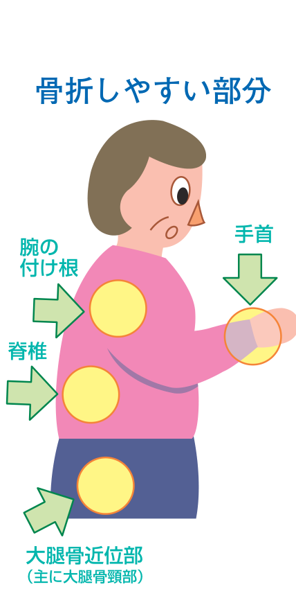 骨粗しょう症で骨折しやすい部分（脊椎、腕の付け根、手首、大腿骨近位部）を示す図