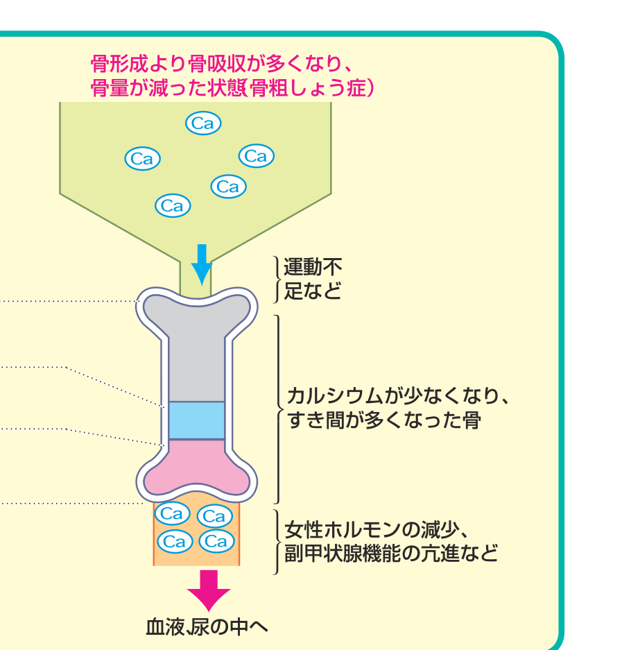 骨吸収が骨形成を上回り骨量が減った、骨粗しょう症の状態を示す図