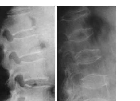 正常な背骨と骨粗しょう症の背骨のレントゲン写真の比較