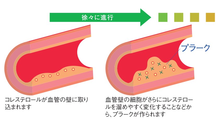 血管の断面図。コレステロールが血管の壁に取り込まれ、やがて血管の内側にプラークが盛り上がっていくようすを2段階で示した図
