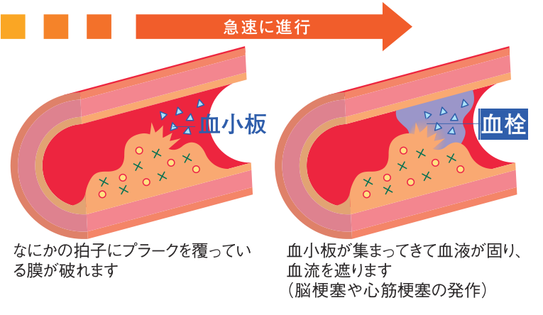 血管の断面図。プラークを覆う膜が破れ、そこに血小板が集まって血栓ができ、血流を遮るようすを2段階で示した図