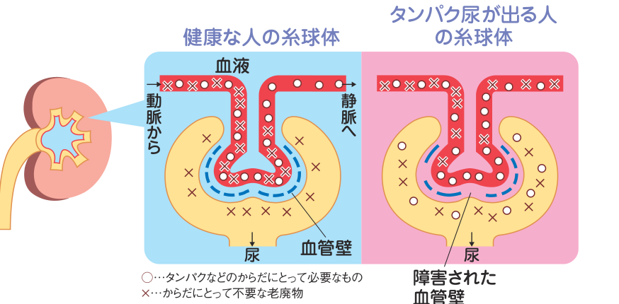 健康な人の糸球体とタンパク尿が出る人の糸球体を比較した図。健康な人ではタンパクは血管壁を通過せず尿に出ないが、タンパク尿が出る人では血管壁が障害され、必要なタンパクも尿に漏れ出るようすを示す