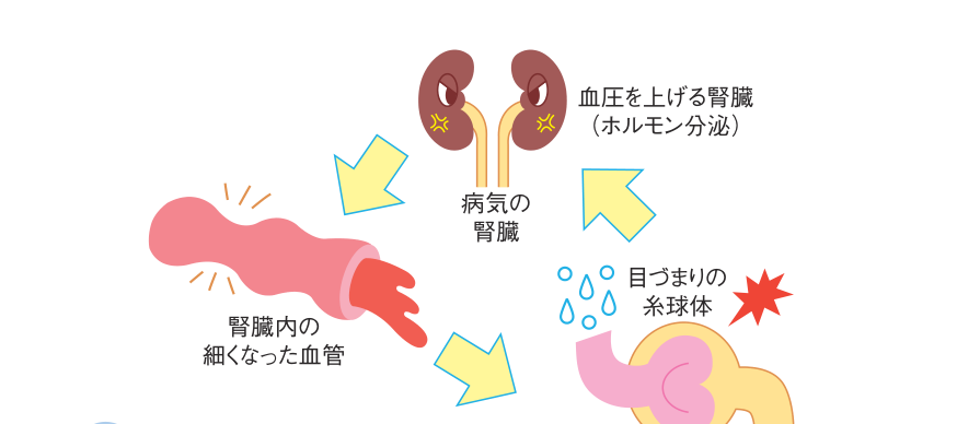 腎臓の血流量が減って病気の腎臓になると、血圧を上げるホルモンが分泌されて血圧が上がり、それが糸球体内の細い血管や腎臓内の血管を傷めて、さらに血流が悪くなるという悪循環を示した図