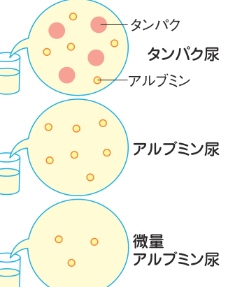 タンパク尿・アルブミン尿・微量アルブミン尿の違いを、尿に含まれるタンパクとアルブミンの粒の量で示した図