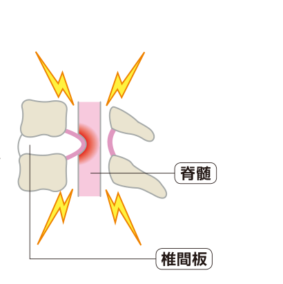 椎間板の中身がずれて飛び出し、脊髄を圧迫しているようすを示した図