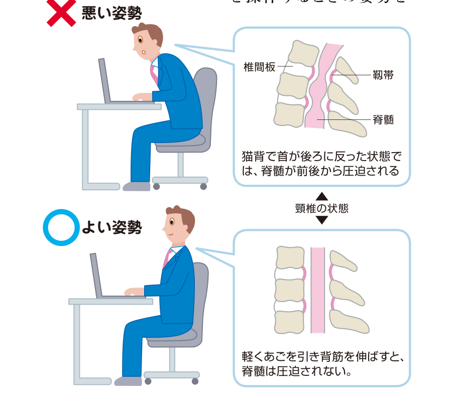 猫背で首が後ろに反った悪い姿勢では脊髄が前後から圧迫されるが、あごを引き背筋を伸ばしたよい姿勢では脊髄が圧迫されないことを示した図
