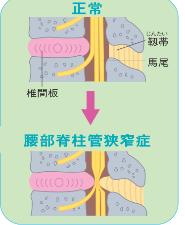 正常な状態と腰部脊柱管狭窄症になったときの断面の比較図。狭窄すると椎間板がふくらんで馬尾を圧迫するようすを示した図