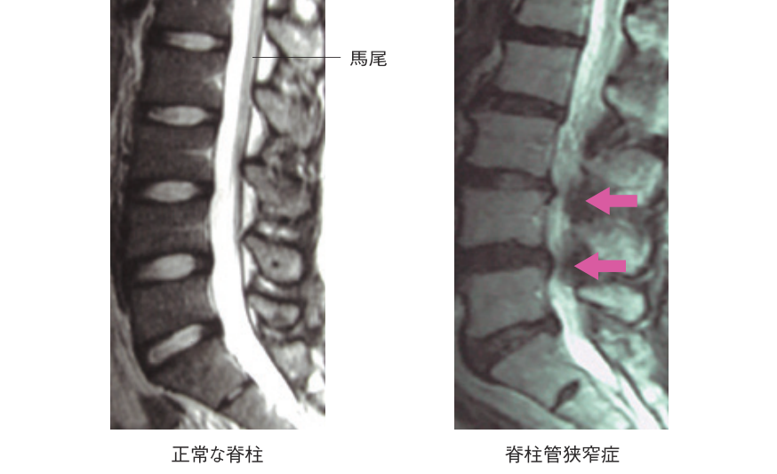 MRIによる検査画像の比較。正常な脊柱と腰部脊柱管狭窄症の脊柱を並べ、狭窄している部分を矢印で示した図