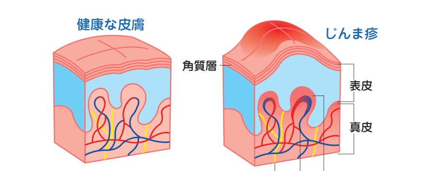 健康な皮膚とじんま疹が起きた皮膚を比較し、血管の拡張と血液の漏出を示した図