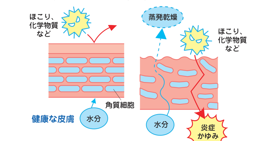 健康な皮膚とアトピー性皮膚炎の皮膚を比較し、バリアー機能の低下による水分の蒸発と刺激物・アレルゲンの侵入を示した図